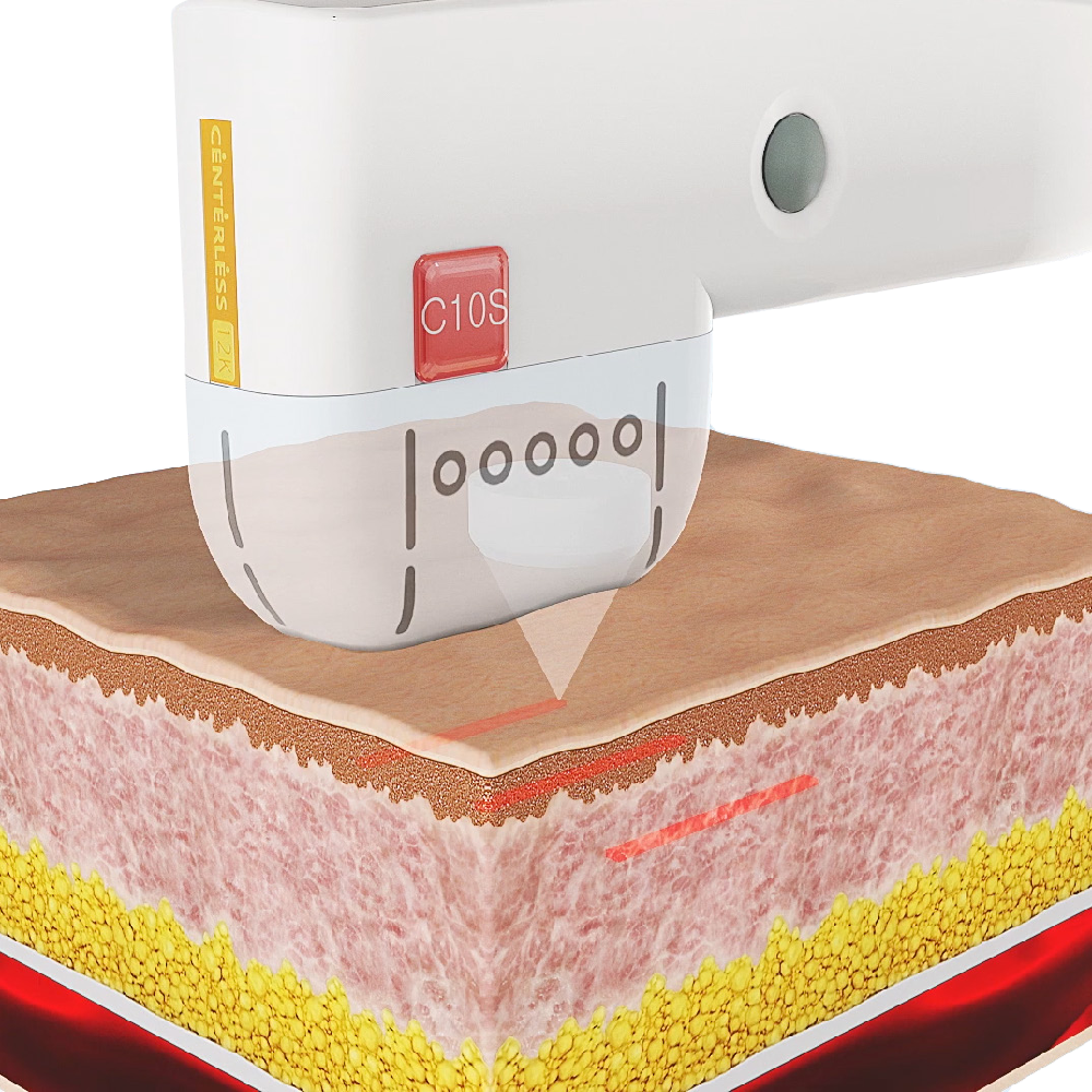 UTIMS A3-R (HIFU device for face & body lifting)